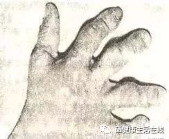 缺硒症状成人怎么补硒