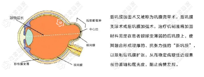 后巩膜加固术需要住院几天