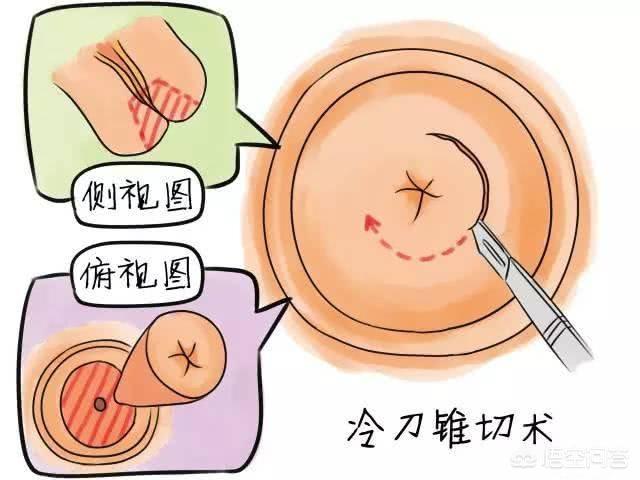 感染hpv52，该怎么办？插图7