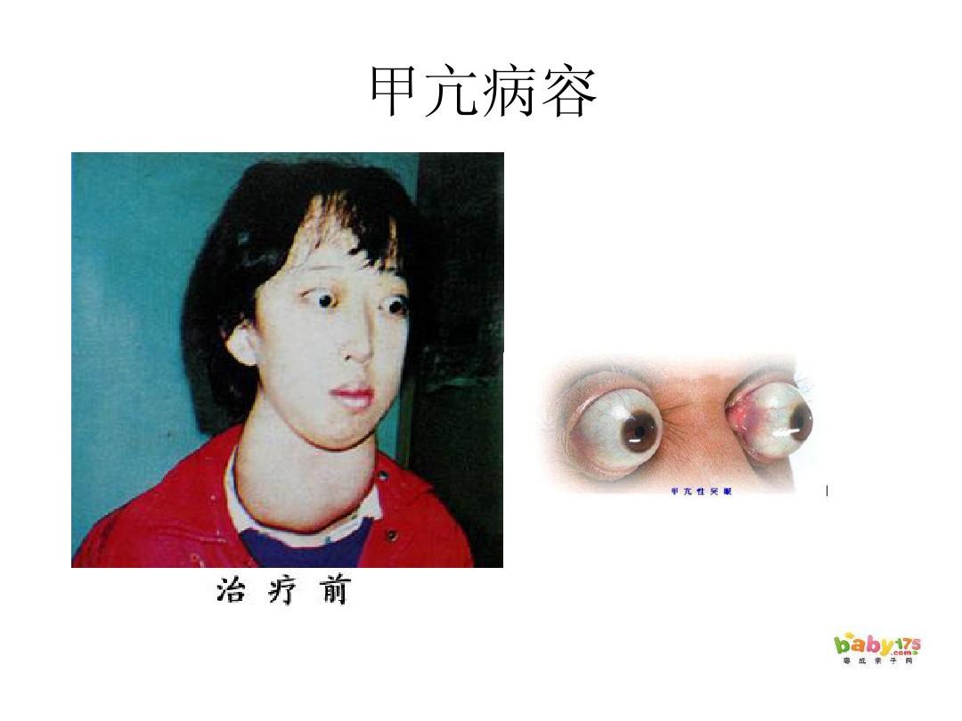 补硒和甲状腺功能亢进