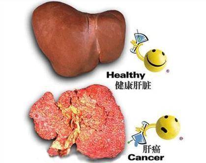 肝硬化患者补什么硒好