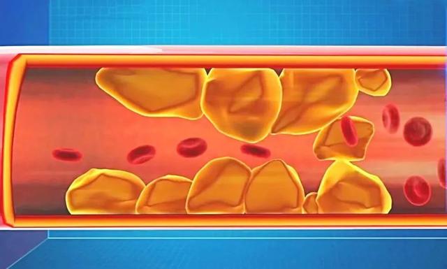 血脂异?；箍梢圆刮穑ú挂斐Ｑ梢猿て诔月穑?硒宝网