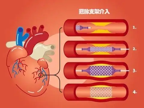 心脏放了支架能补硒吗