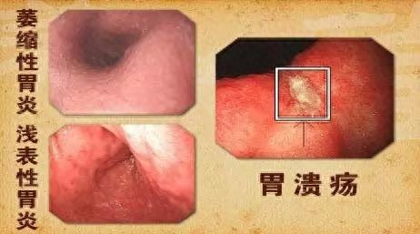 胃溃疡怎么补硒元素多