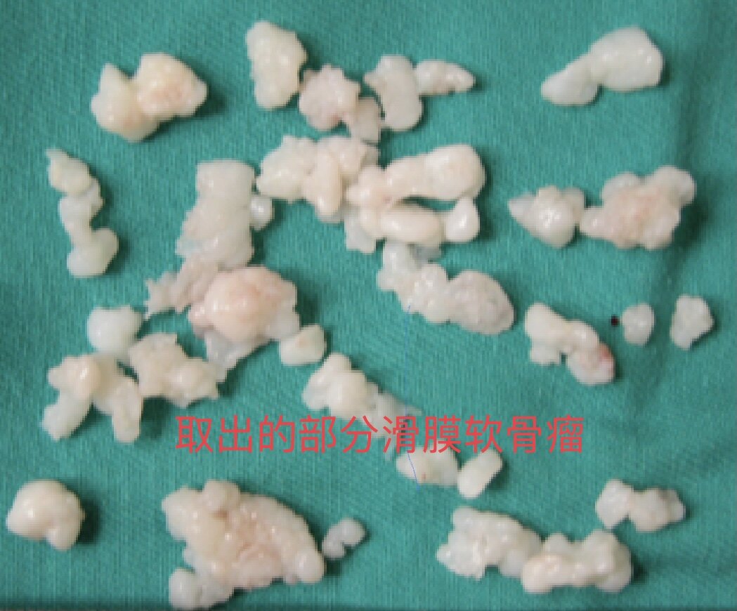 补硒会导致口腔溃疡嘛