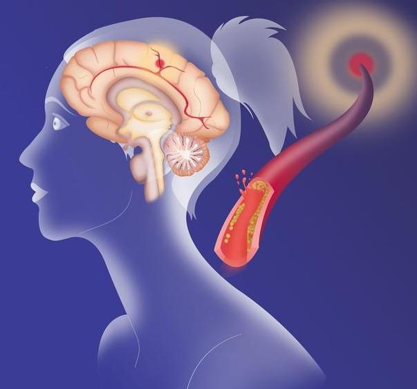 出现4个症状，暗示脑血管堵了！尽早就医，别拖到脑梗死才后悔