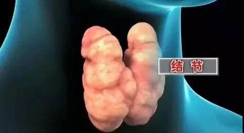 甲状腺疾病高发，到底该如何防治？这次专家终于讲清楚了……