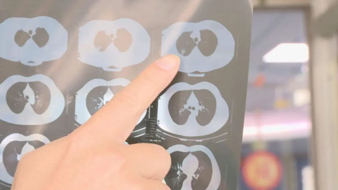 肺结节 补硒(硒对肺结节有作用吗)-硒宝网