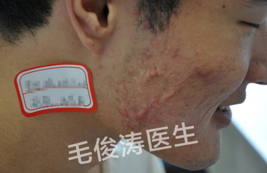补硒治下巴痘