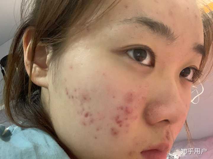 补硒治下巴痘