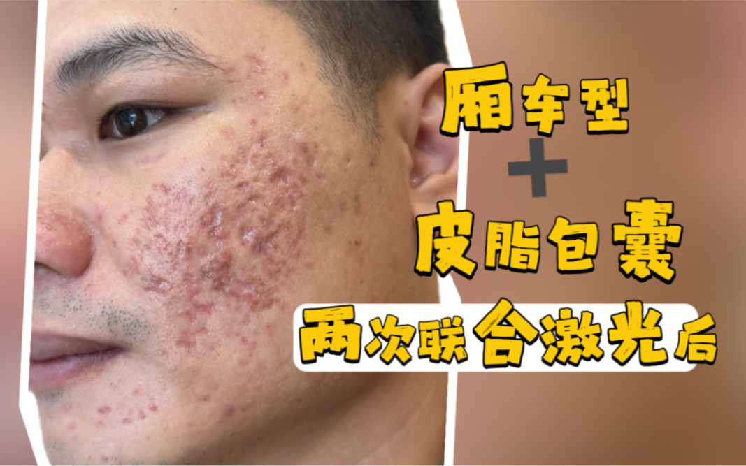 补硒治下巴痘