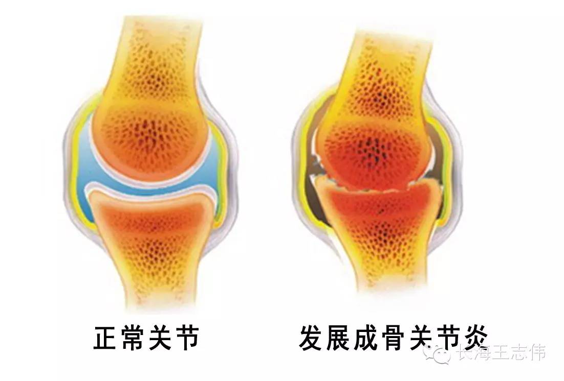 大骨节病补硒(补硒治疗大骨节病)-硒宝网