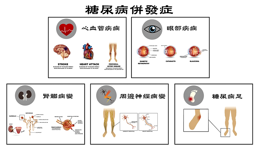 补硒治糖尿?。ú刮悄虿。?硒宝网