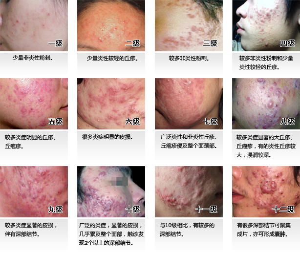 脸上有痤疮要补锌多久