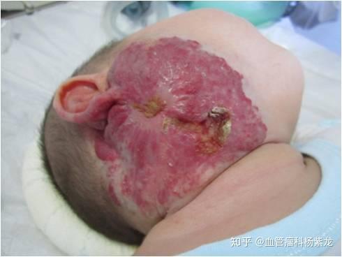 锌硒宝治疗?。ㄐ课τ行Ч穑?硒宝网
