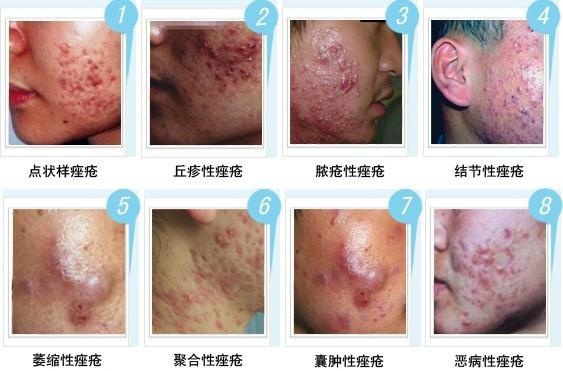 锌硒宝治痤疮(锌痤疮)-硒宝网