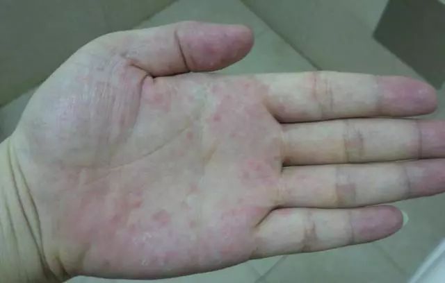 肝癌晚期 补硒