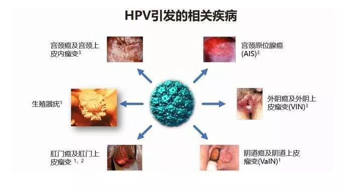 补硒防止hpv