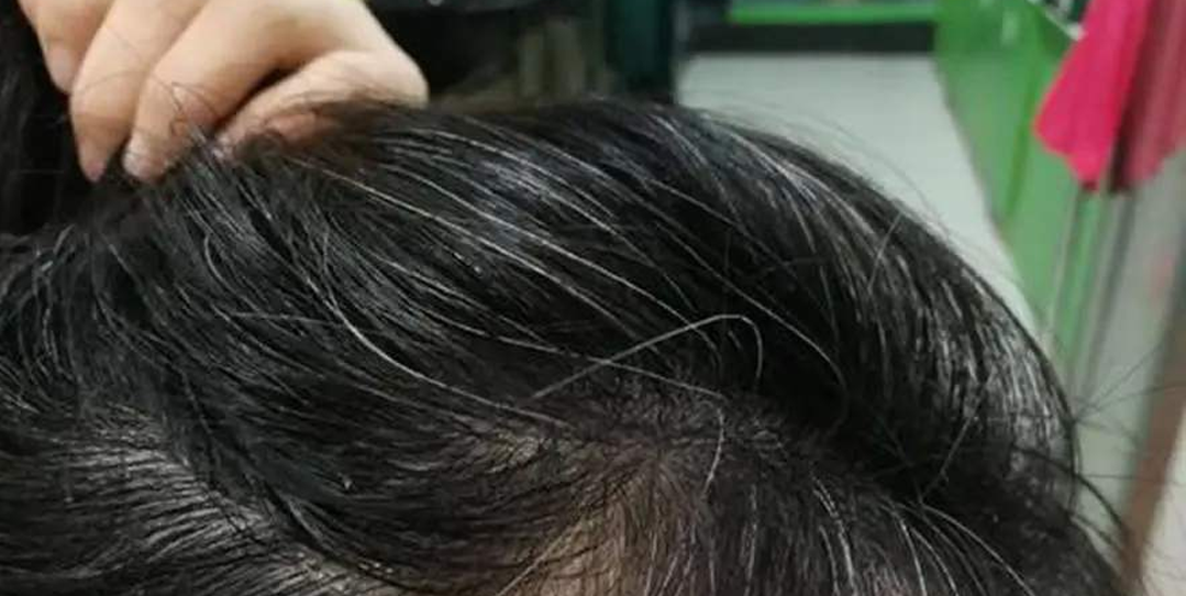 补硒能改善白发