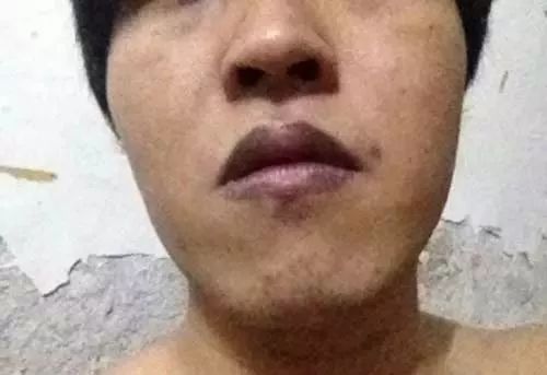 补硒后皮肤发黄