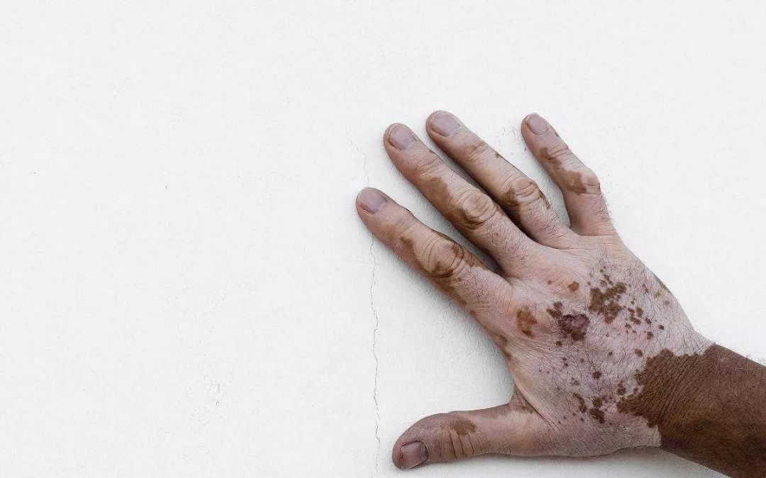 补硒会导致贫血