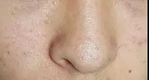 长痤疮要补硒吗