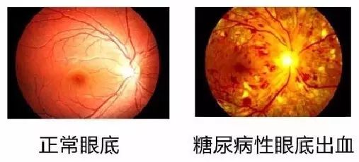 补硒预防糖尿?。ㄔし啦〔固悄蛭姆椒ǎ?硒宝网