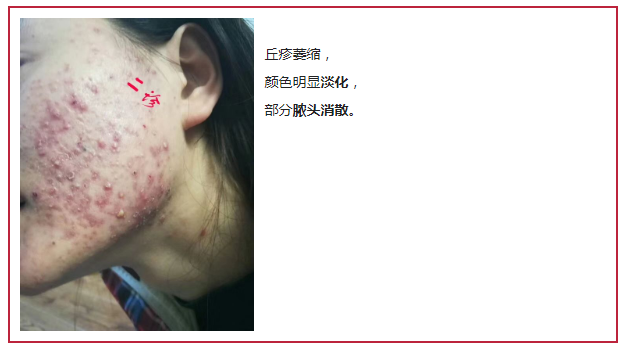 补硒治愈银屑?。ㄖ斡〔刮疾〉囊┪铮?硒宝网