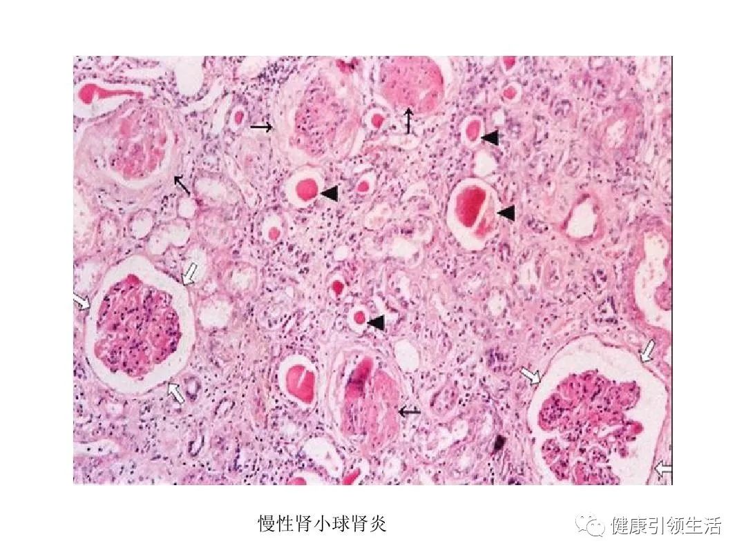 补硒对肾病好吗