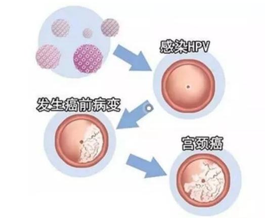 HPV阳性严不严重？感染者自己说了算，善用一个阳性转阴的办法