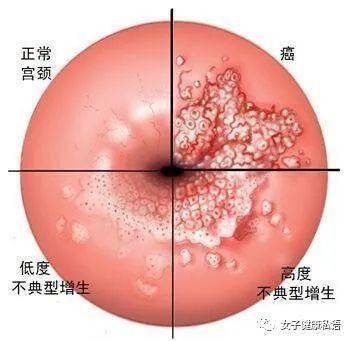 hpv高危阳补硒