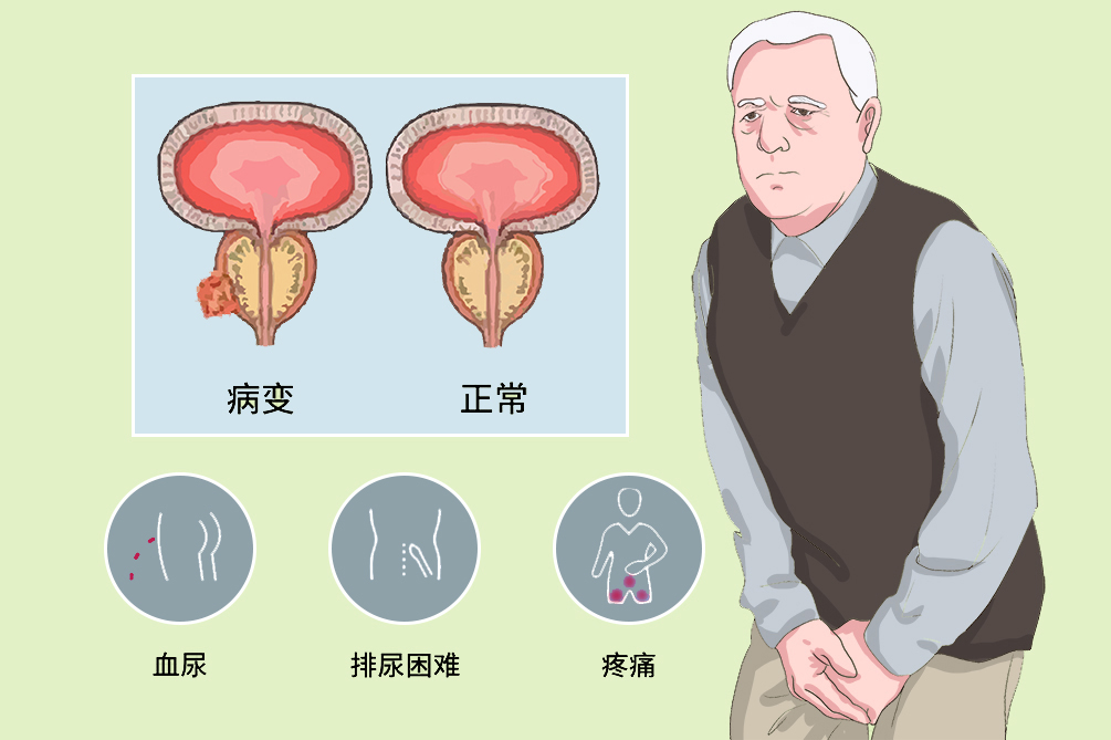 全民补硒防癌抗癌