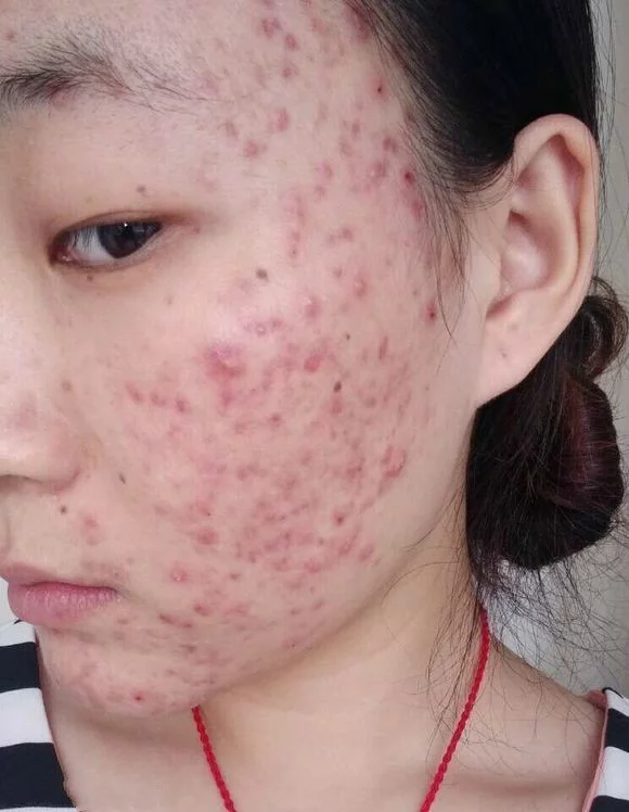 补硒后脸上起痘痘