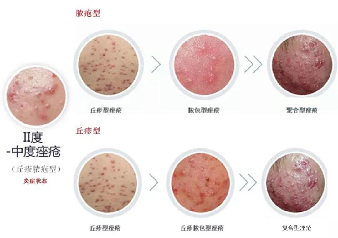 补硒后脸上起痘痘