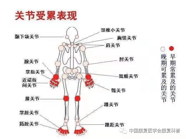 补硒治疗大骨节?。ㄎ氪蠊墙诓〉墓叵担?硒宝网