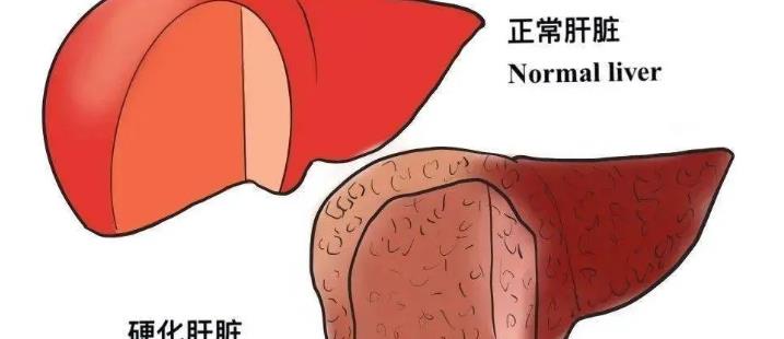 肝病为什么要补硒(补硒治愈了我的肝?。?硒宝网
