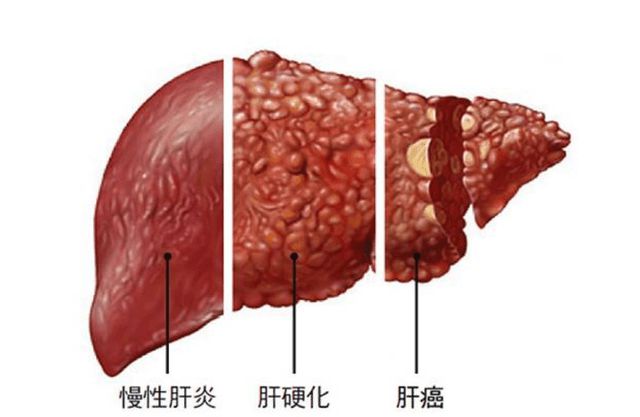 肝病为什么要补硒(补硒治愈了我的肝病)-硒宝网