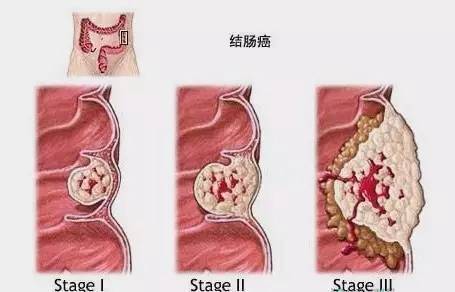 脑肿瘤需要补硒吗