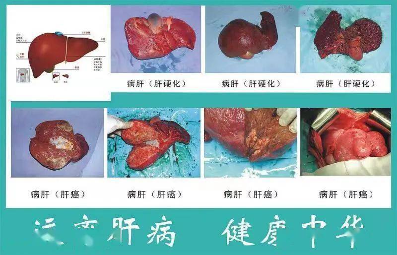 个人乙肝能补硒吗