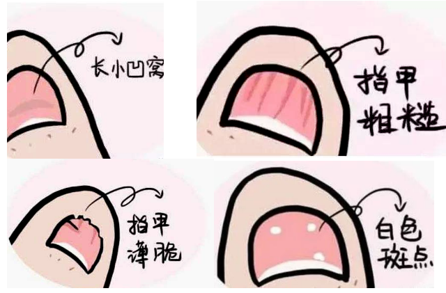 补硒 甲营养不良