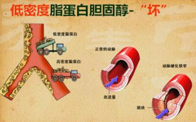 脑?；颊呷绾尾刮? /></p>
<p>建议每天多喝水的同时，搭配一些绿瓶西维e来吃，让血脂水平得到有效控制，防止并发出现心脑血管问题。</p>
<p>如果你想彻底控制血脂，你应该养成1个习惯！</p>
<p>不难发现，在日常生活中，肥胖者高血脂的可能性更大，这是因为血液循环慢，脂肪会积聚在血管中，从而阻断血液的正常循环，而适当的运动不仅能维持体内甘油三酯的平衡，而且有助于人体脂质和胆固醇的代谢。尤其是中老年人，要进行适当的锻炼，照顾好健康。</p>										<div   id="zptmy5zary"   class="single-copyright">
						版权声明：本文为互联网用户自发贡献的内容，其中观点及相关内容仅代表作者本人。本网站仅提供信息存储空间服务，不拥有这些内容的所有权，并且不承担任何法律责任。如果发现本网站上有涉嫌侵权或违法违规的内容，请立即联系我们的客服QQ：6532516以便进行及时清除。					</div>
									</div>
                <div   id="zptmy5zary"   class="mb-default clearfix">
										<a class="float-left btn btn-outline-default mr-small" href="http://www.jkassets.cn/tag/%e8%84%91%e6%a2%97%e6%82%a3%e8%80%85%e5%a6%82%e4%bd%95%e8%a1%a5%e7%a1%92/">脑梗患者如何补硒</a>
									</div>          
				<div   id="zptmy5zary"   class="log-neighbor clearfix">
					<a href="http://www.jkassets.cn/35148.html" rel="prev"><span>上一篇：</span>刚生牛犊几天补硒（牛犊补硒方法）</a>					<a href="http://www.jkassets.cn/35150.html" rel="next"><span>下一篇：</span>补硒会不会嗜睡呢（补硒睡眠好）</a>				</div>
                <div   id="zptmy5zary"   class="log-readmore">
					<h5 class="page-header">继续阅读</h5>
					<ul>
											<li><span id="zptmy5zary"    class="page-dot"></span><a href="http://www.jkassets.cn/35146.html">脑?；颊呷绾尾刮怨２刮苡寐穑?/a></li>
										</ul>
				</div>
            </div>
        </div>
<div   id="zptmy5zary"   class="col-right d-none d-lg-block">
		<div   id="zptmy5zary"   class="sidebar-box">
		<h4 class="sidebar-title">随机文章</h4>
		<div   id="zptmy5zary"   class="sidebar-log">
			<ul>
								<li><a href="http://www.jkassets.cn/70847.html" target="_blank">儿童补钙哪种好（儿童款补钙首选产品）</a></li>
								<li><a href="http://www.jkassets.cn/18305.html" target="_blank">富硒大米圆粒（富硒的大米）</a></li>
								<li><a href="http://www.jkassets.cn/75202.html" target="_blank">起头皮屑补硒维生素b2（有头皮屑吃维生素有什么作用）</a></li>
								<li><a href="http://www.jkassets.cn/70114.html" target="_blank">富硒地瓜什么时候成熟（富硒地瓜甜吗）</a></li>
								<li><a href="http://www.jkassets.cn/65080.html" target="_blank">微量元素检测仪（测微量元素的仪器多少钱一台）</a></li>
								<li><a href="http://www.jkassets.cn/72571.html" target="_blank">补硒指的什么食物含硒多（硒的补充食物）</a></li>
								<li><a href="http://www.jkassets.cn/27051.html" target="_blank">平菇粉能补硒吗（能补粉平菇硒元素吗）</a></li>
								<li><a href="http://www.jkassets.cn/55308.html" target="_blank">什么是富硒农业产品（富硒功能农业）</a></li>
								<li><a href="http://www.jkassets.cn/58919.html" target="_blank">补钙药（药补钙好还是吃食物好）</a></li>
								<li><a href="http://www.jkassets.cn/20362.html" target="_blank">中老年补钙吃什么钙片（补钙老年吃钙片中药有哪些）</a></li>
							</ul>
		</div>
	</div>
			<div   id="zptmy5zary"   class="sidebar-box js_asd_bottom">
		<div   id="zptmy5zary"   class="sidebar-custom">
			<a href="" rel="nofollow" target="_blank">
				<img src="http://www.jkassets.cn/wp-content/uploads/2023/12/1593602619028180.jpg"></a>
		</div>

	</div>
	</div>    </div>
</div>
 <div   id="zptmy5zary"   class="footer-wrap">
	<div   id="zptmy5zary"   class="container">
		<div   id="zptmy5zary"   class="row">
			<div   id="zptmy5zary"   class="col-12">
				
<a href="http://www.jkassets.cn/privacy-policy/">隐私政策</a>

								<a rel="nofollow"  target="_blank">陕ICP备2021015245号-4</a><a href="/sitemap.xml">网站地图</a>
								<span>© 硒宝网</span>
			</div>
		</div>
	</div>
</div>
<a class="page-backtop"><i class="fa fa-icon fa-angle-up"></i></a>
<script>
var swiper = new Swiper(