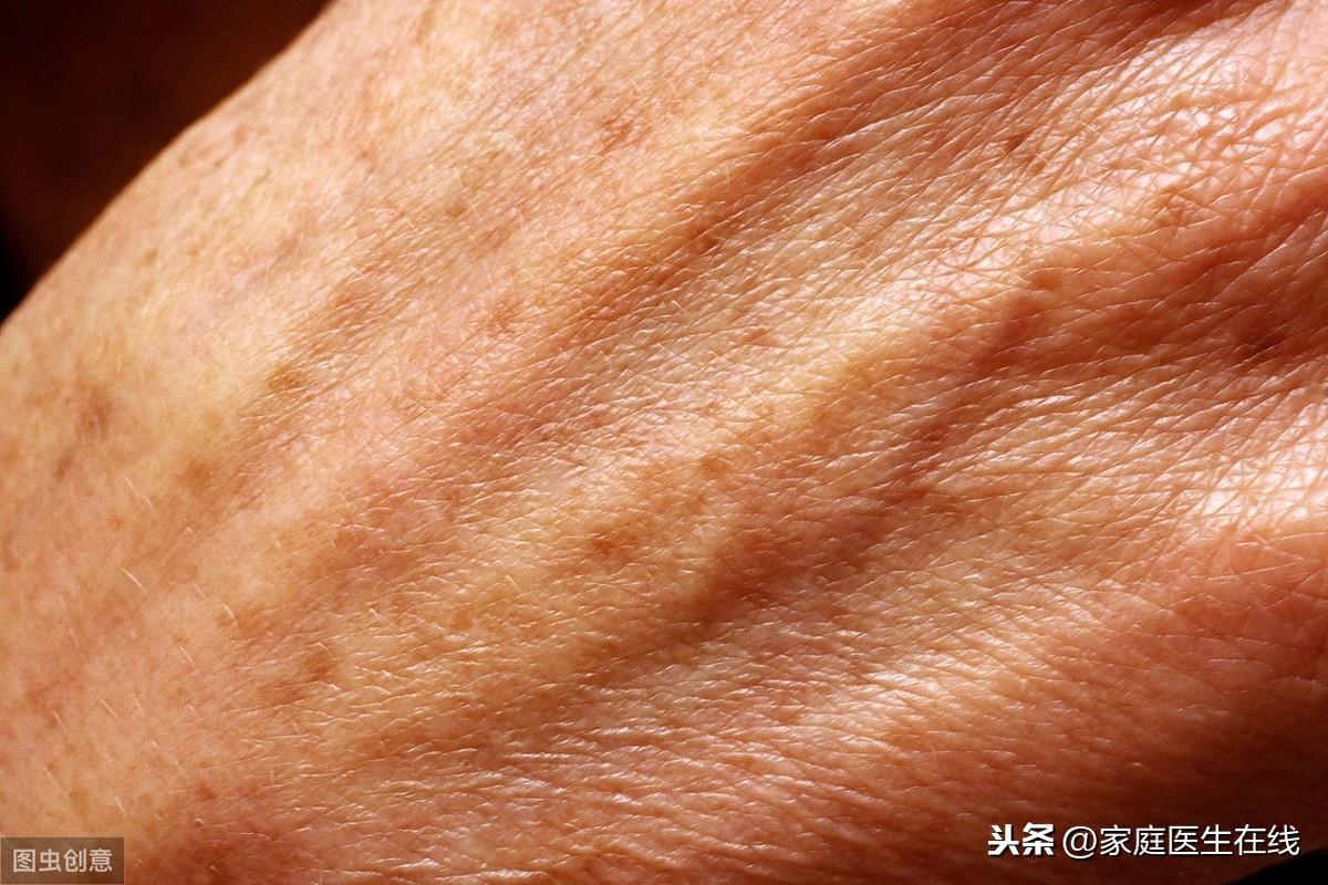 补硒能去老年斑吗