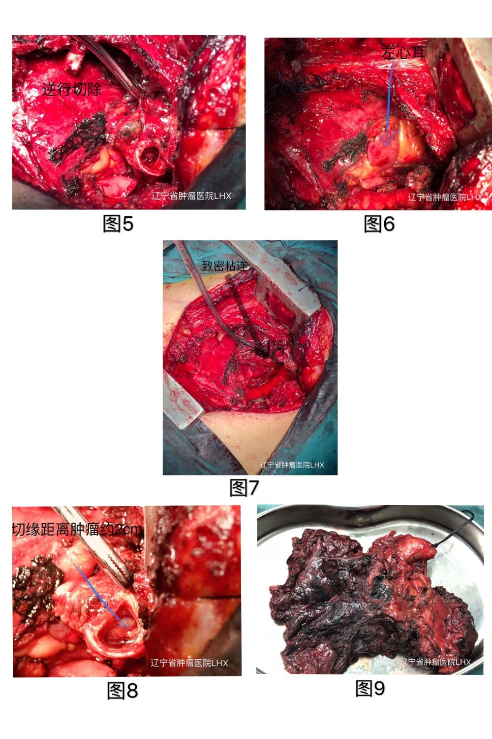 化疗病人补硒的药