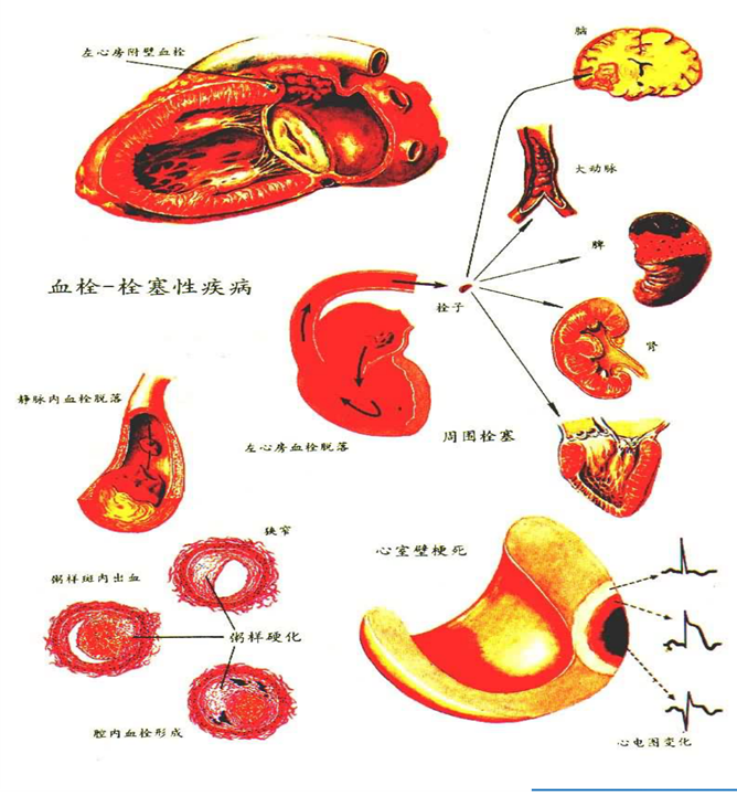 扩张型心肌病补硒