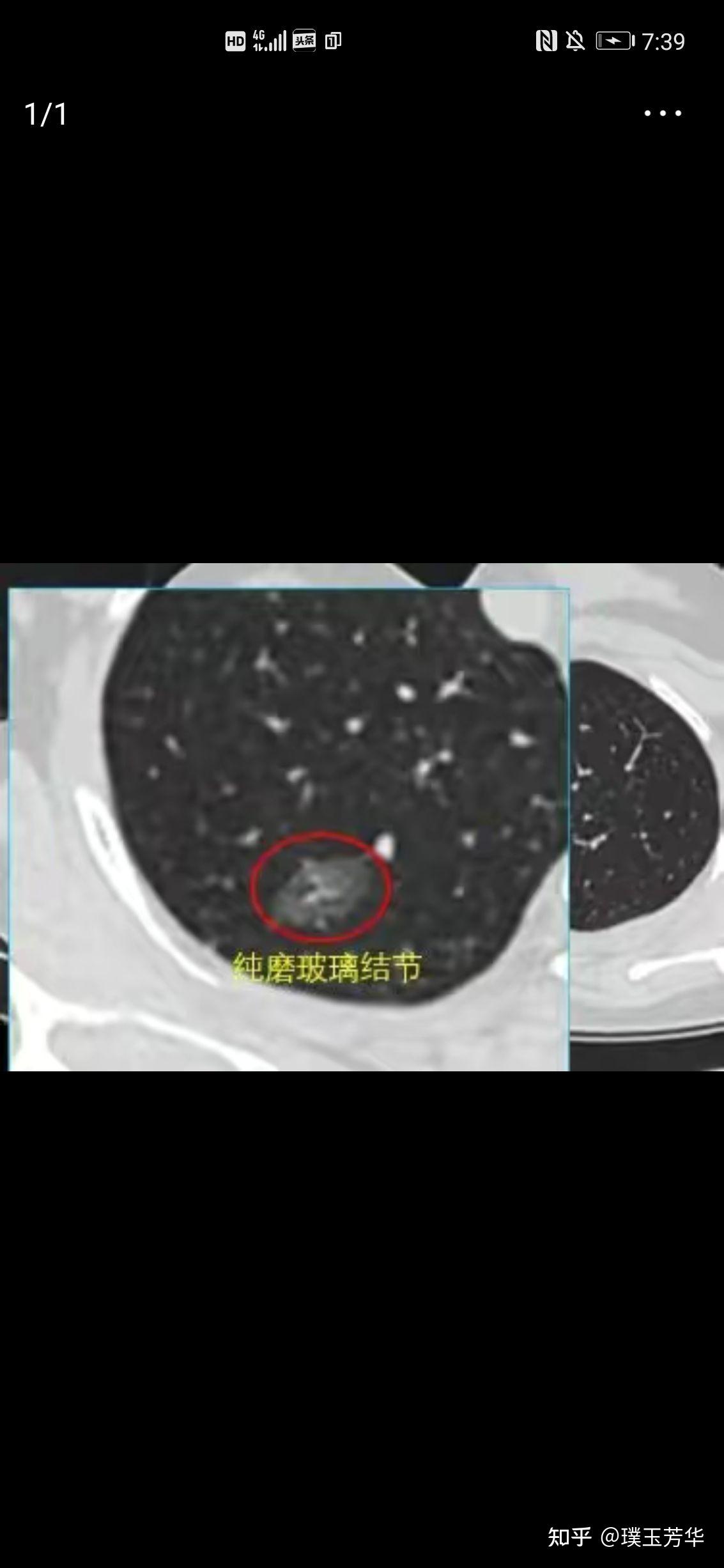 补硒对慢型克山病(硒对克山病的作用)-硒宝网