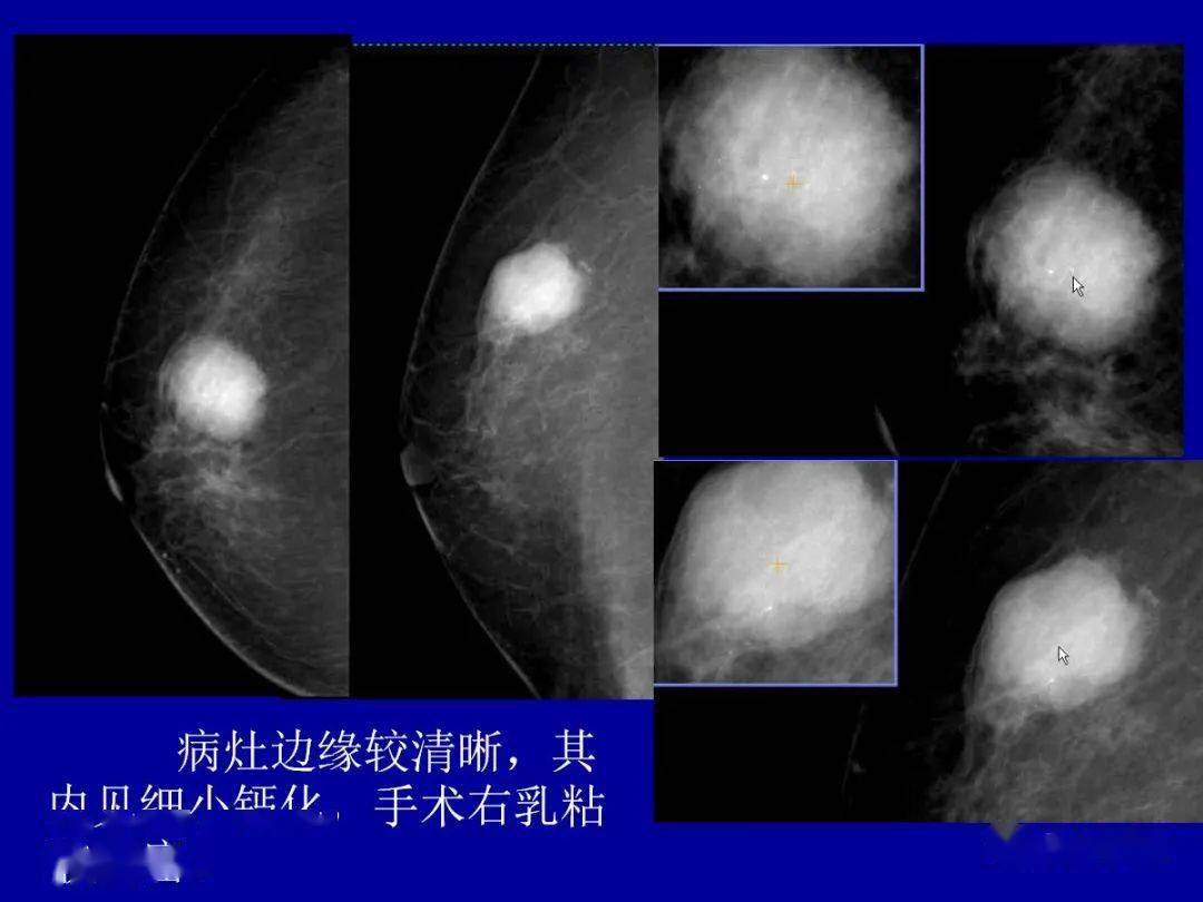 补硒对慢型克山?。ㄎ钥松讲〉淖饔茫?硒宝网