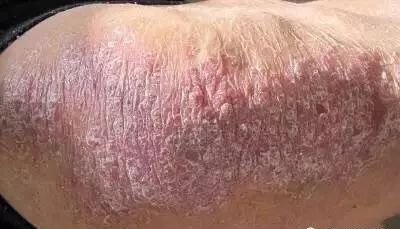 银屑病患者补硒吗(硒缺乏银屑?。?硒宝网