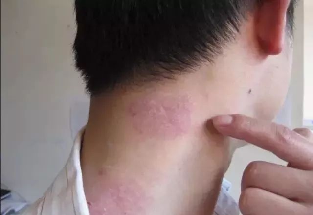 银屑病患者补硒吗(硒缺乏银屑?。?硒宝网