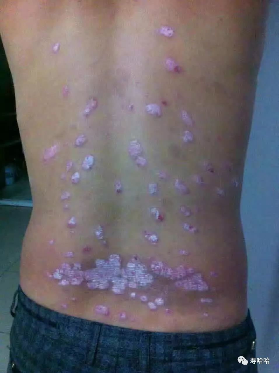 银屑病患者补硒吗(硒缺乏银屑?。?硒宝网
