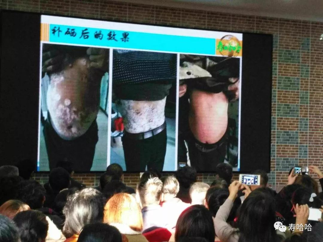 银屑病患者补硒吗(硒缺乏银屑?。?硒宝网
